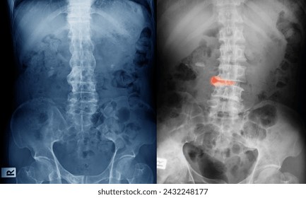 X-ray image of spine, AP view, show ankylosing spondylitis lumbar.

