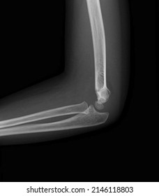 An x-ray image of  supracondylar humerus  fracture  
