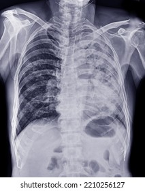 X-ray Image Suspected Thoracic Lung Cancer