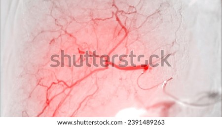 X-ray image of TACE or Chemoembolization is a procedure that allows a dose of chemotherapy drugs to be administered directly to Liver tumor or HCC.