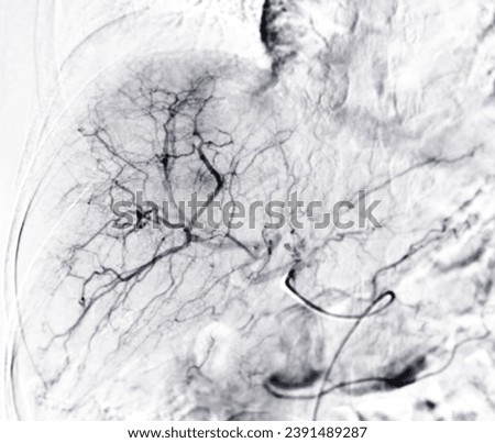 X-ray image of TACE or Chemoembolization is a procedure that allows a dose of chemotherapy drugs to be administered directly to Liver tumor or HCC.