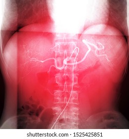 X-ray image of TOCE or Chemoembolization is a procedure that allows a dose of chemotherapy drugs to be administered directly to Liver tumor or HCC.
