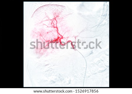 X-ray image of TOCE or Chemoembolization is a procedure that allows a dose of chemotherapy drugs to be administered directly to Liver tumor or HCC.