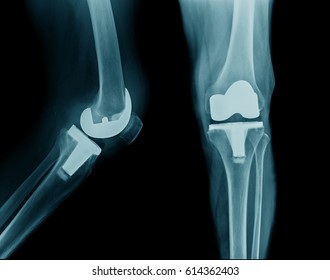 X-ray image total knee arthroplasty