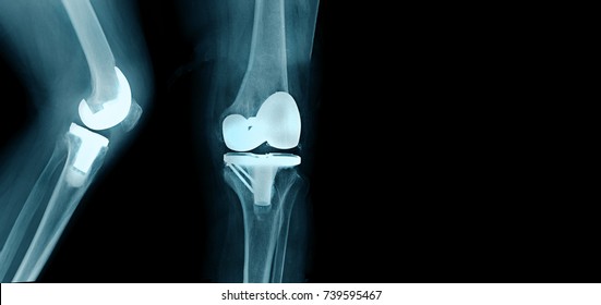 X-ray Image Total Knee Arthroplasty 
