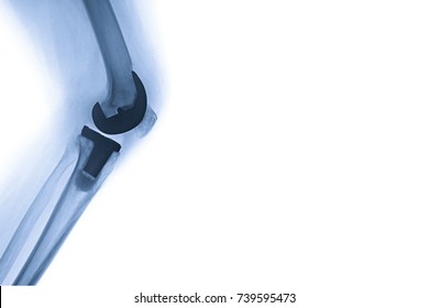 X-ray image total knee arthroplasty, TKA banner
