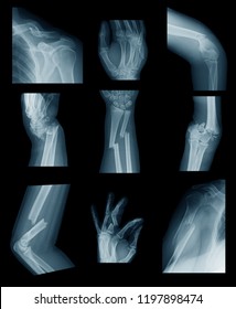 X-ray Image Of Upper Extremity Fractures