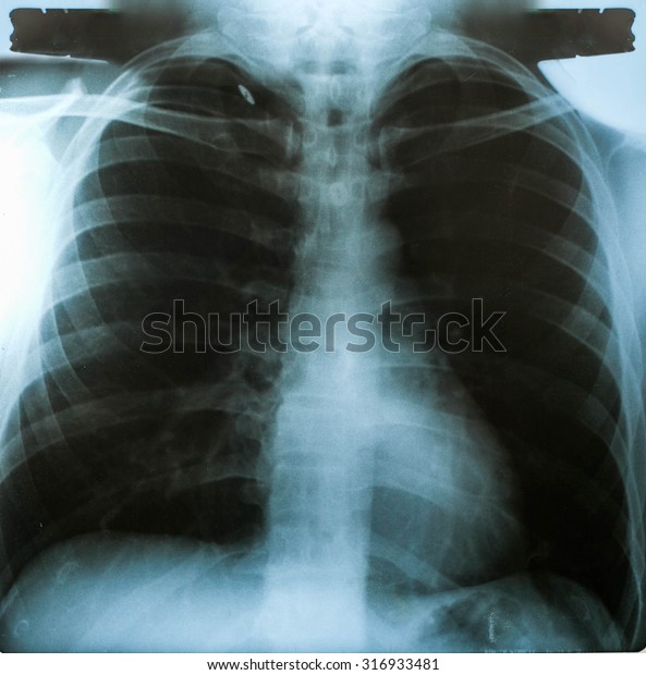 Xray Image View Chest Men Medical Stock Photo (Edit Now) 316933481