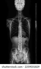 Imagen de rayos X de la columna vertebral completa para diagnóstico de escoliosis de la columna vertebral.