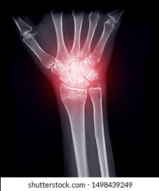 X-ray image of wrist joint Ap view for diagnostic rheumatoid arthritis . - Shutterstock ID 1498439249