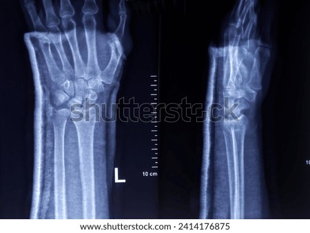 X-ray image of Wrist joint both view. Plaster cast obscured the bony details. Comminuted fracture is noted at the lower end of radius.