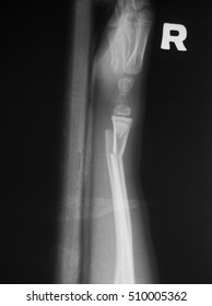 Xray Image Wrist Joint Children Lateral Stock Photo 510005362 ...