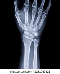 X-ray image of wrist joint for diagnosis rheumatoid arthritis . - Shutterstock ID 2251049321