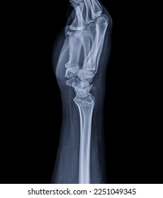 X-ray image of wrist joint for diagnosis rheumatoid arthritis . - Shutterstock ID 2251049345