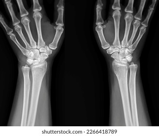 X-ray image of  wrist joint front view of normal wrist joint. - Shutterstock ID 2266418789