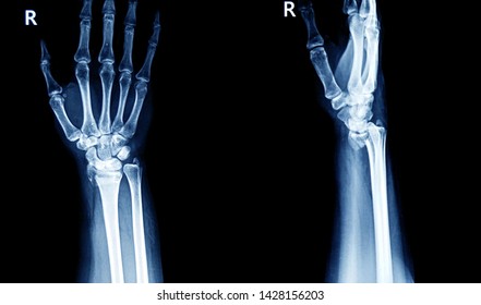  X-ray image of wrist joint, show fracture wrist and human hand                              