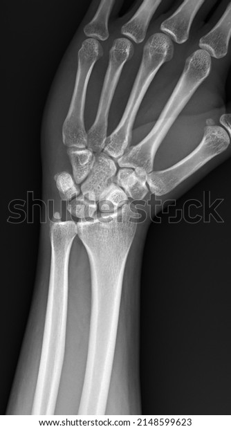 Xray Image Wrist Position Radial Deviation Stock Photo 2148599623 ...