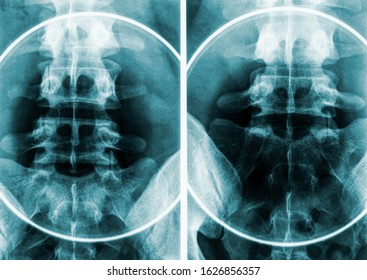 X-ray Imagery Or Radiography Of Human Male Pelvis And Lumbar Vertebrae.