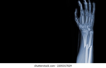 x-ray images of the both hand and wrist joint ap views to see injuries radius and ulna bond fracture for a medical diagnosis.Medical image concept and copy space. - Shutterstock ID 2205317029