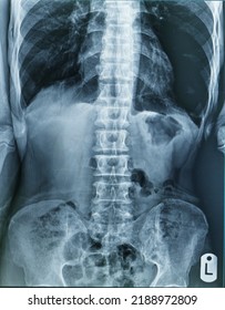 Xray Images Chest Abdomen Stock Photo 2188972809 | Shutterstock