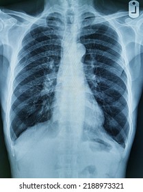 Xray Images Chest Abdomen Stock Photo 2188973321 | Shutterstock