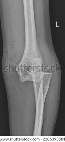 X-ray images displaying displaced ulna.