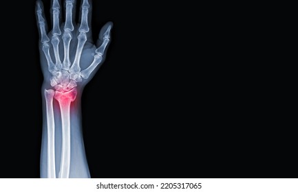 x-ray images of the hand and wrist joint AP views to see injuries tendons and radius bond fracture for a medical diagnosis.Medical image concept and copy space. - Shutterstock ID 2205317065