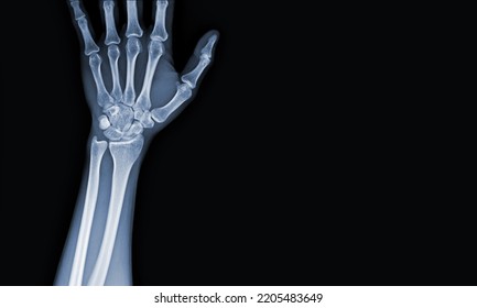 X-ray Images Of The Hand And Wrist Joint To See Injuries Tendons Soft Tissue Swelling For A Medical Diagnosis.Medical Image Concept And Copy Space.