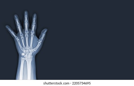 X-ray Images Of The Hand And Wrist Joint AP Views To See Injuries Tendons Soft Tissue Swelling For A Medical Diagnosis.Medical Image Concept And Copy Space.