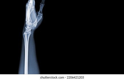 X-ray Images Of The Hand And Wrist Joint Lateral Views To See Injuries Tendons Soft Tissue Swelling For A Medical Diagnosis.Medical Image Concept And Copy Space.