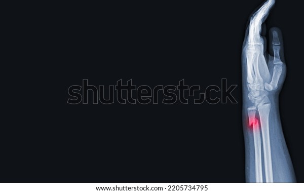 Xray Images Hand Wrist Joint Lateral Stock Photo 2205734795 | Shutterstock