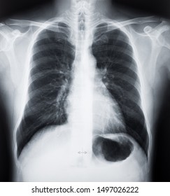 X-ray Images Of Human Chest Or Lung. CT Scan Film.