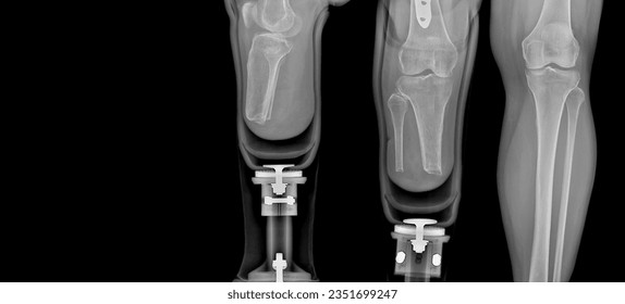 X-ray images of prostheses and real legs, lateral ap and lat internal images, normal tones, black background. - Powered by Shutterstock