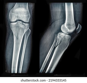 Xray Images Showing Real Fracture Of Broken Leg Bone Under The Knee After Injury