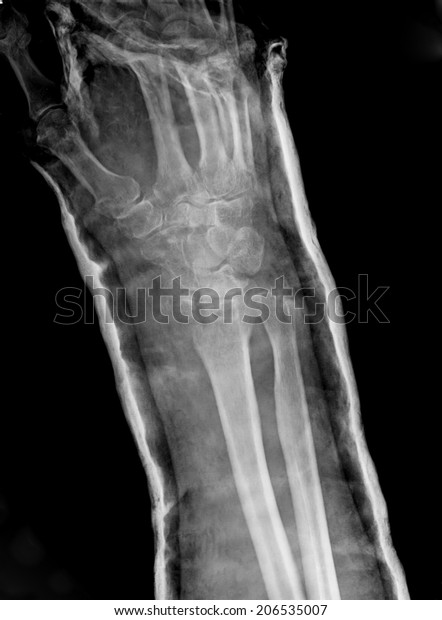 Xray Imaging Epiphysial Radial Fracture Wrist Stock Photo (Edit Now ...