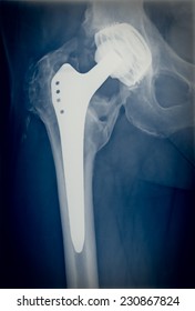 Xray Imaging Of Permanent Total Hip Arthroplasty