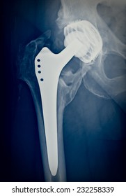 Xray Imaging Of Permanent Total Hip Arthroplasty