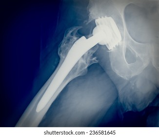 Xray Imaging Of Permanent Total Hip Arthroplasty