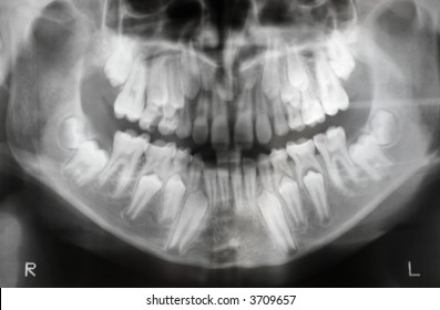 X-ray Of Jaw With Two Pairs Of Teeth (milk Teeth And Regular Teeth), Soft Focus