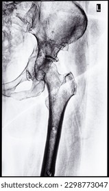 x-ray of junction of tibia and pelvis after healed of fracture of acetabular cavity