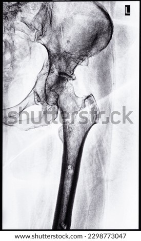 x-ray of junction of tibia and pelvis after healed of fracture of acetabular cavity
