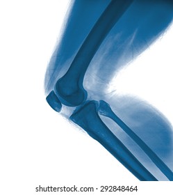 X-ray of a knee