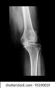x-ray knee