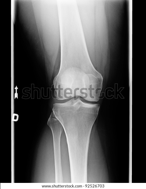 Xray Knee Chondromalacia Condition Level 1 Stock Photo 92526703 ...