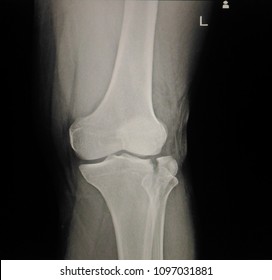 anterior tibial plateau fracture