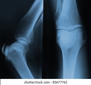 366 Cartilage Damage Stock Photos, Images & Photography 