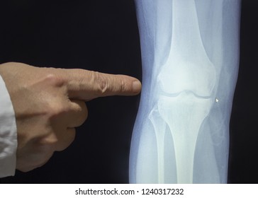 An Xray Of A Knee With A Hand Of Doctor Witch Pointing To A Fracture