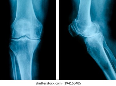 X-Ray of knee joint / Advanced osteoarthritis