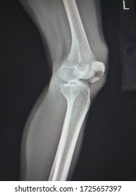 X-ray Knee Joint (AP )Showing Transverse Fracture Of Patella Or Kneecap,Severe Swelling Of Soft Tissue.Medical Healthcare Concept.