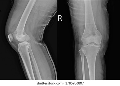 X-ray Knee Joint (AP,LATERAL)Views A Female 15 Year Old Showing Osteosarcoma.Medical Healthcare Concept.